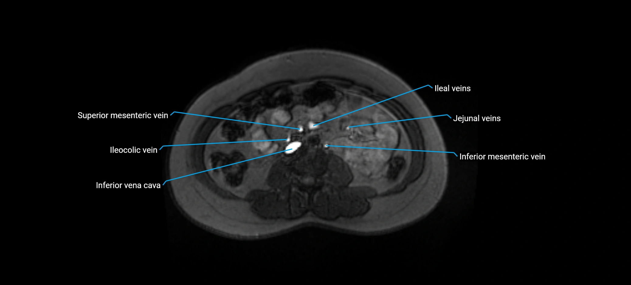 MRV abdomen pelvis & lower limb axial cross sectional anatomy labelled MRI image 95 (1).webp